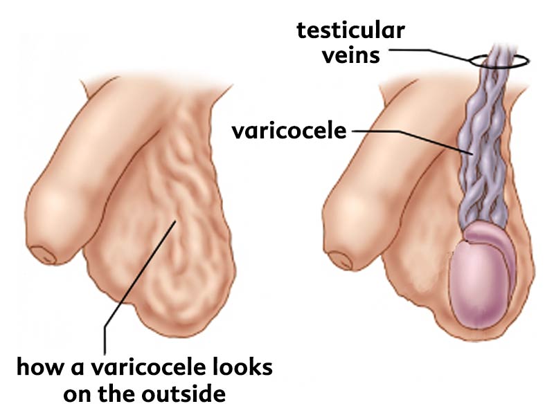آزواسپرمی (Azoospermia)