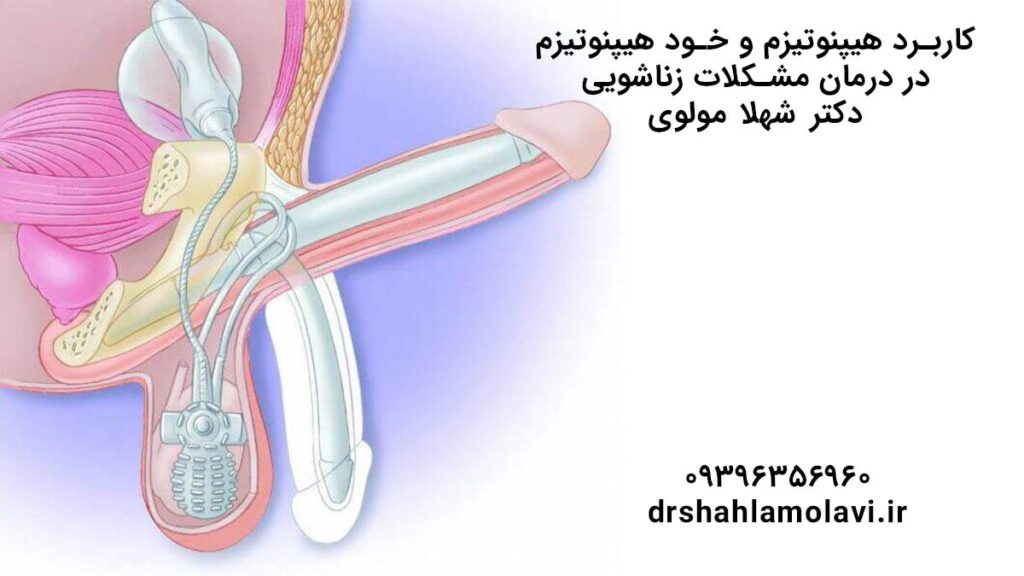 درمان اختلالات جنسی با هیپنوتیزم