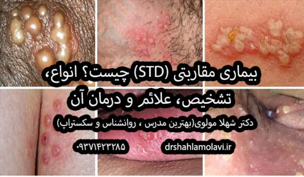 بیماری‌های مقاربتی (STD)